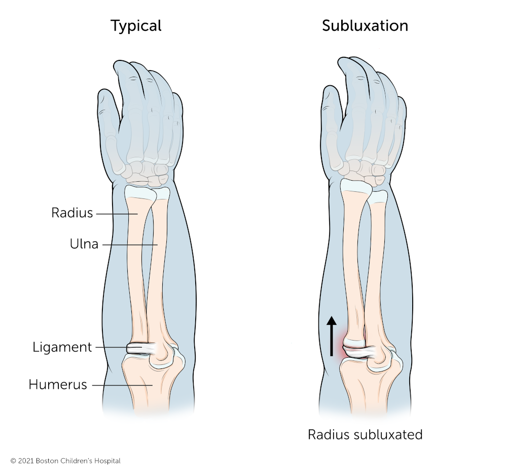 肘关节一种保姆的肘关节，其桡骨部分与肘关节分离