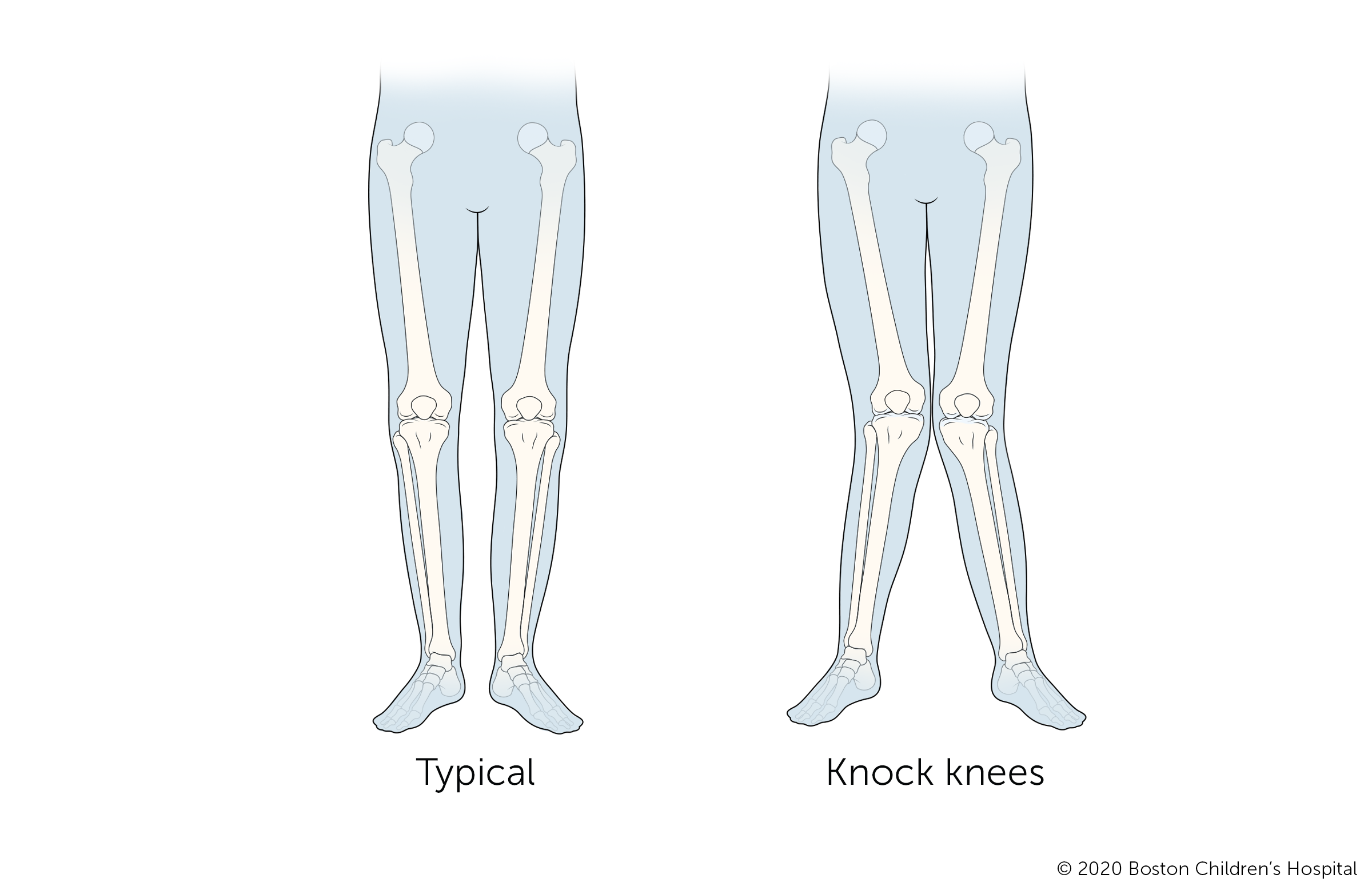 当孩子有双膝撞击时，他们的膝盖向内倾斜，而他们的脚踝保持分开。