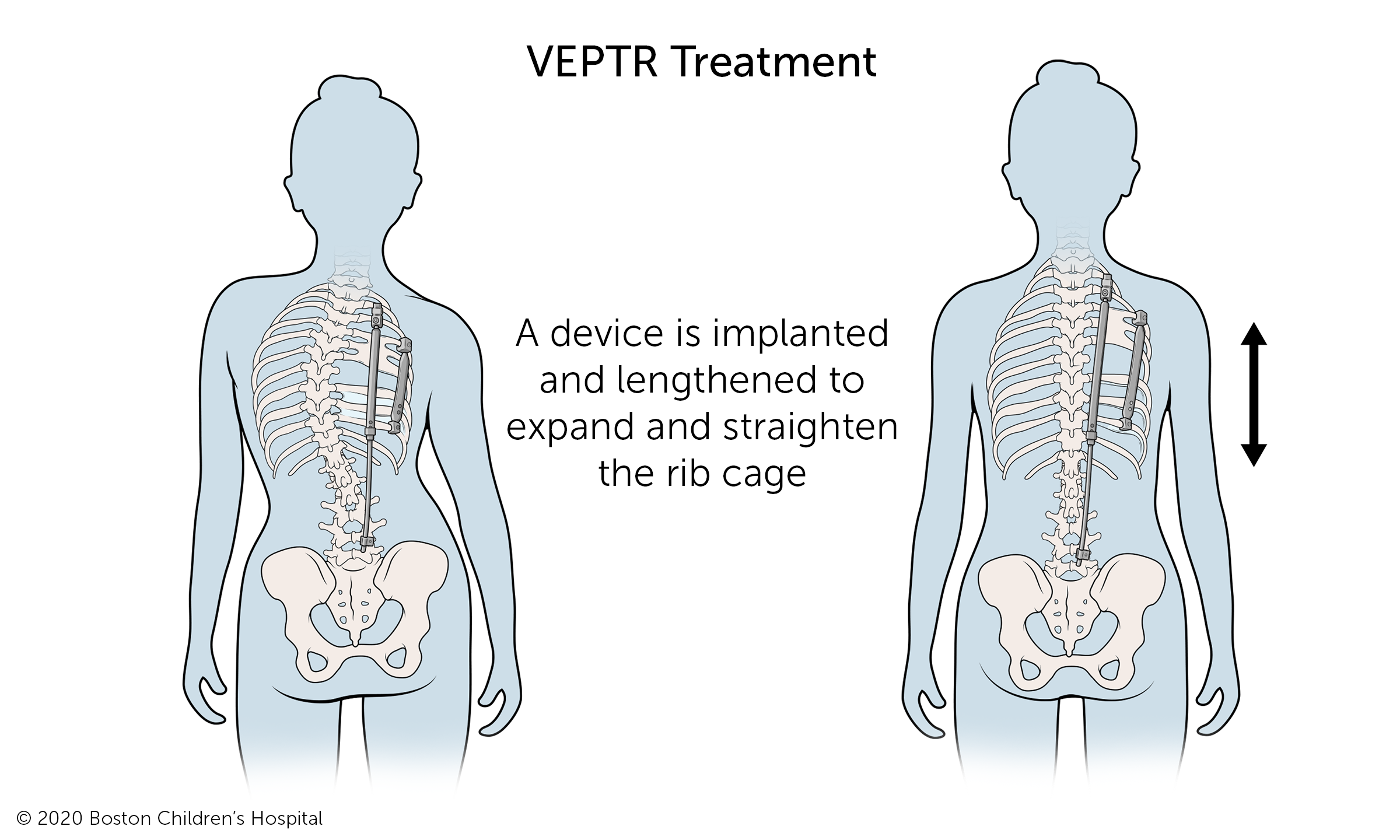 VEPTR™治疗:植入设备并延长以扩大和拉直胸腔。