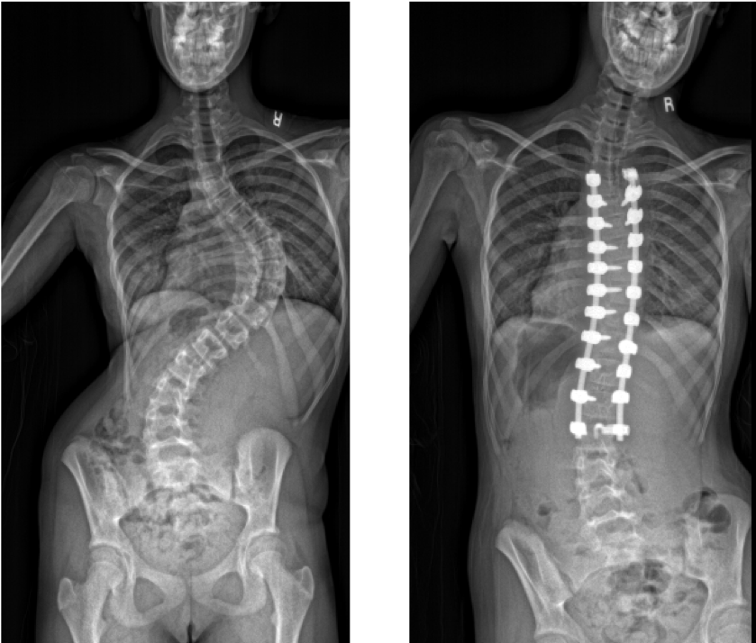 用Mazor X检查术前和术后脊柱X光片