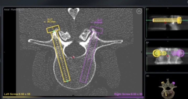 额外的术前或术中规划视图选项，允许可视化计算地形(CT)解剖和规划椎弓根螺钉轨迹