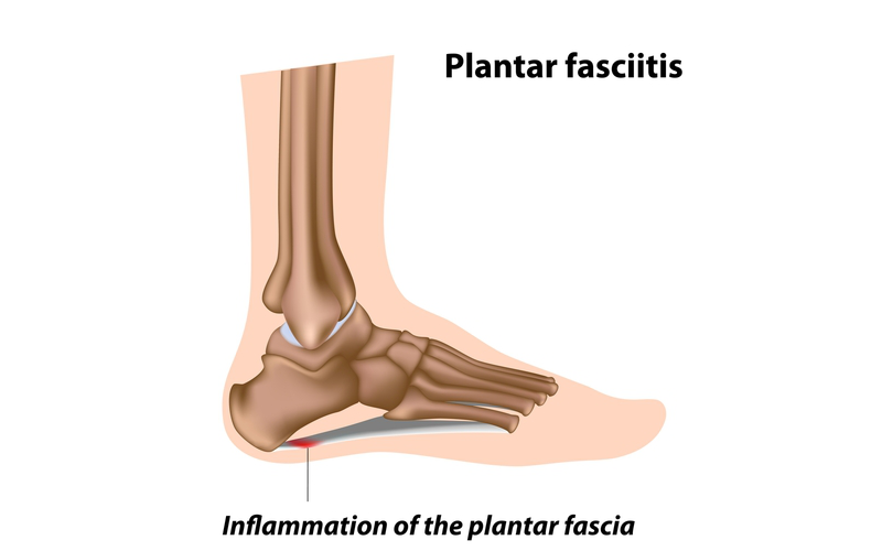 足底筋膜炎是指一只或两只脚后跟底部的疼痛，是由足底筋膜受到刺激引起的。足底筋膜是连接脚后跟和脚趾的致密组织带。