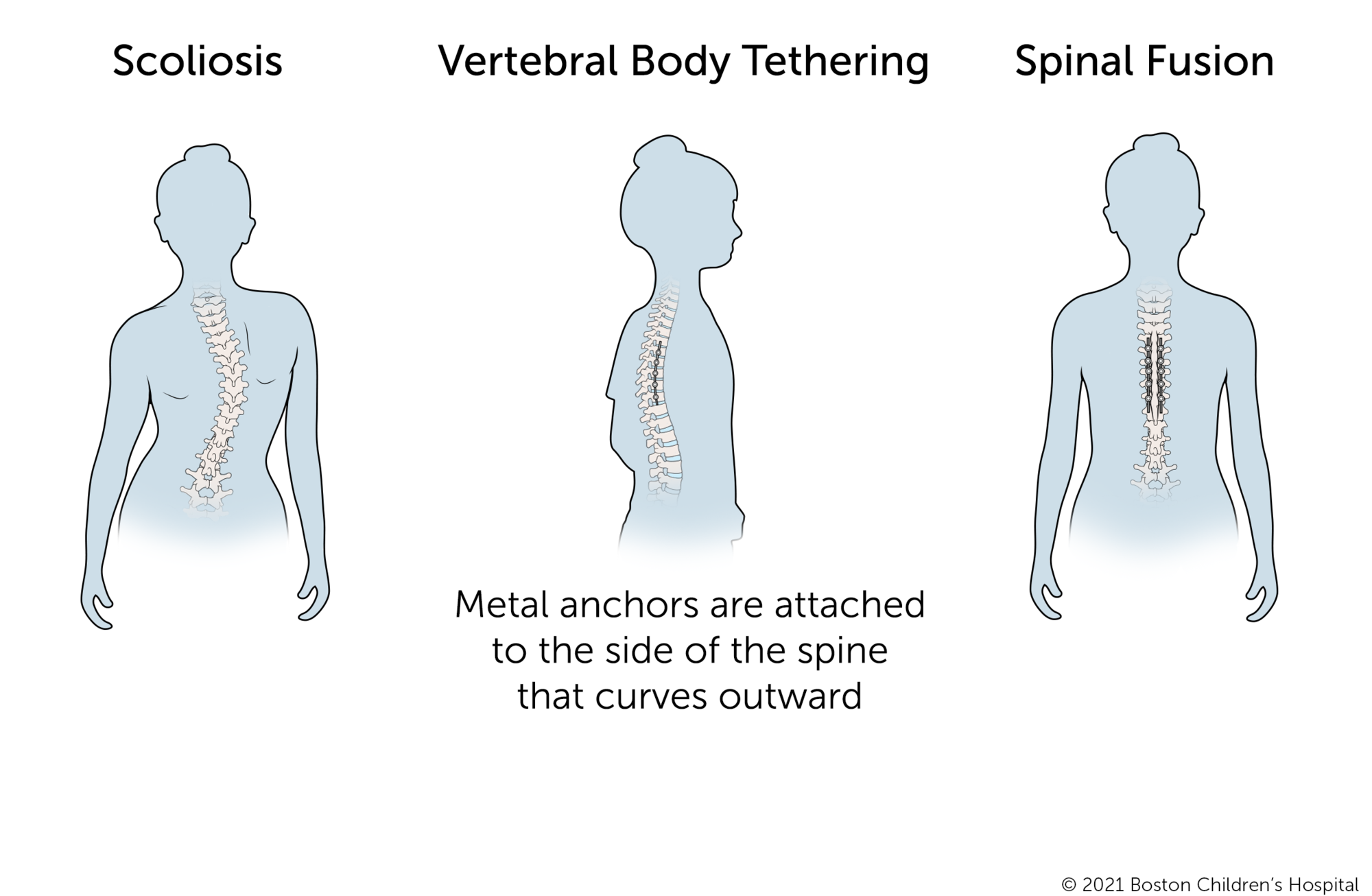 椎体束缚是轻度脊柱侧凸的新方法。金属锚和柔性系绳附着在向外弯曲的脊柱的一侧。相比之下，对于脊柱融合手术，金属锚和硬杆附着在脊柱的两侧。
