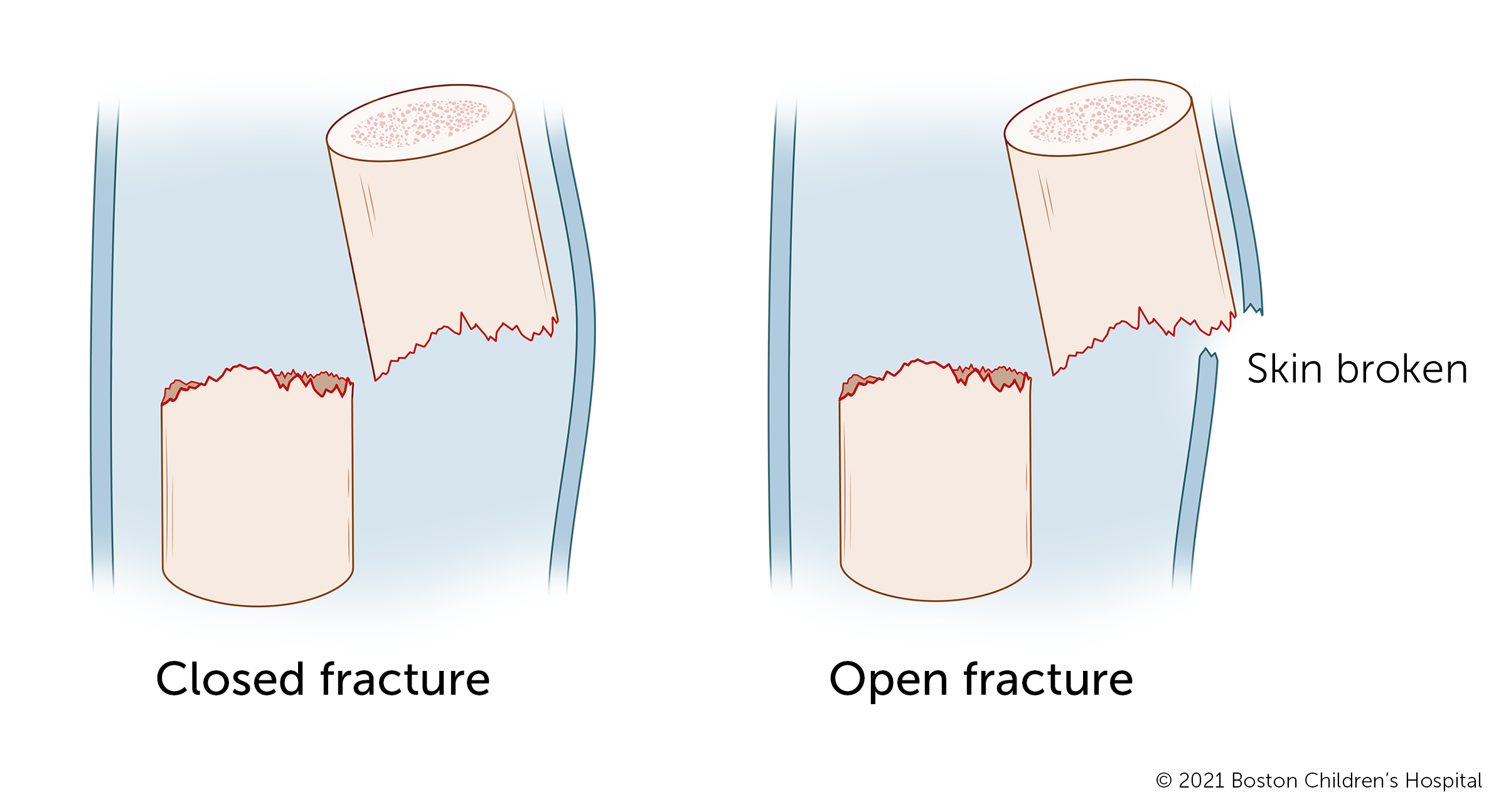开放性和闭合性骨折的图示