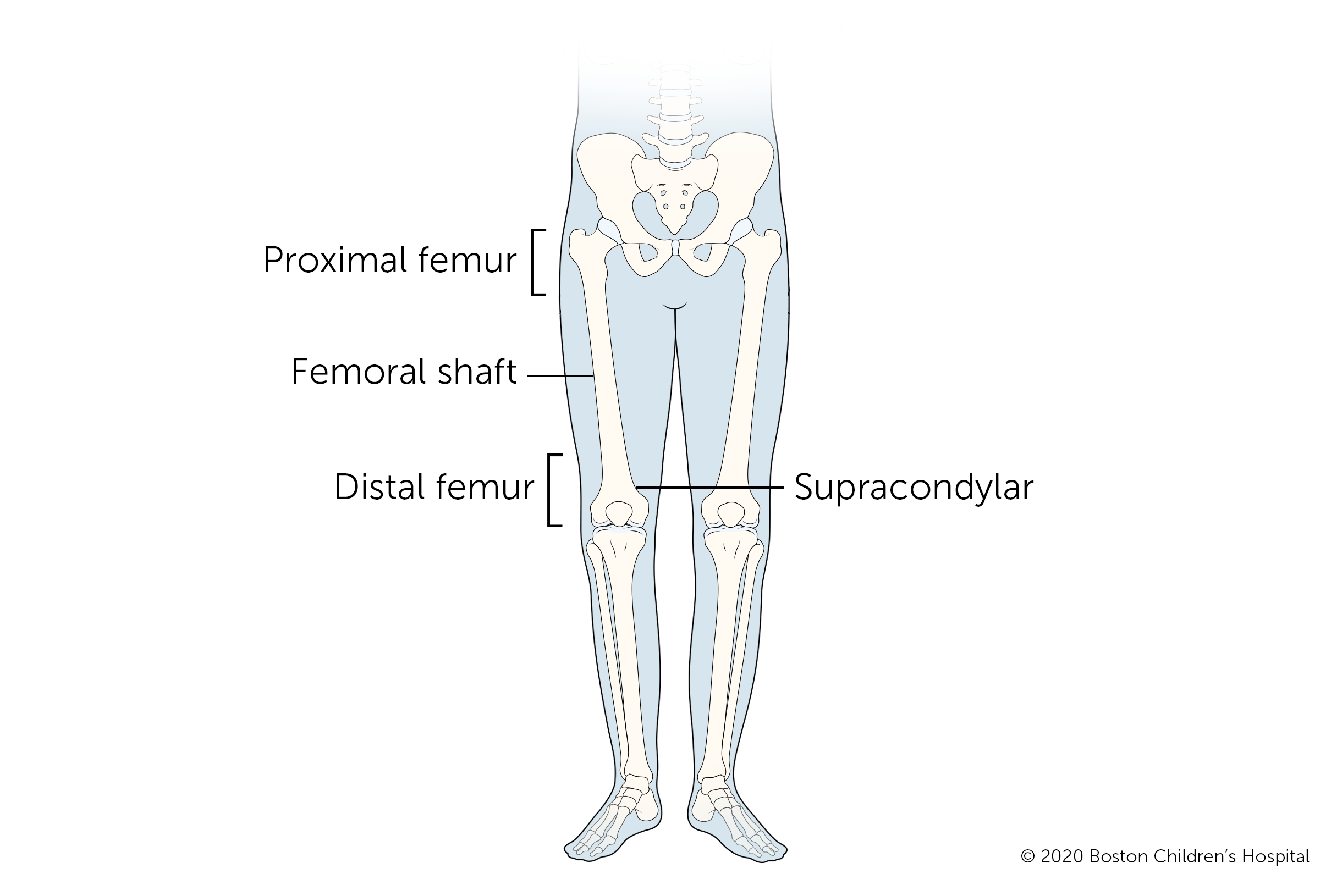 四种类型的腿骨折(股骨骨折)是股骨近端、股骨干、股骨髁上和股骨远端。