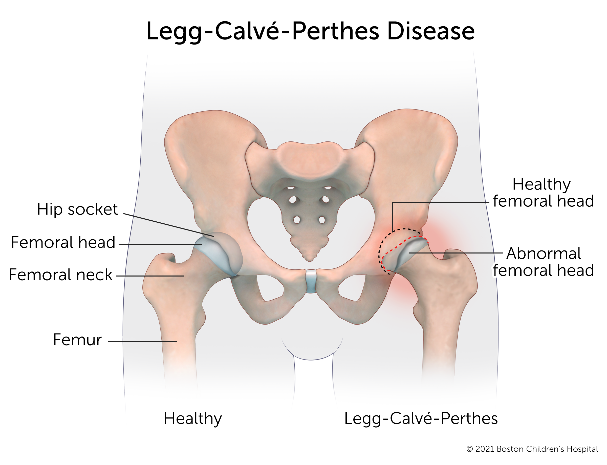 一个健康的髋关节与一个患有小腿雷公病的髋关节相比。在健康的髋关节中，股骨头是圆的，并且安全地嵌入髋臼。在髋关节的Perthes病中，股骨头已经变平，在臼腔中有一个空腔袋。周围区域红肿。