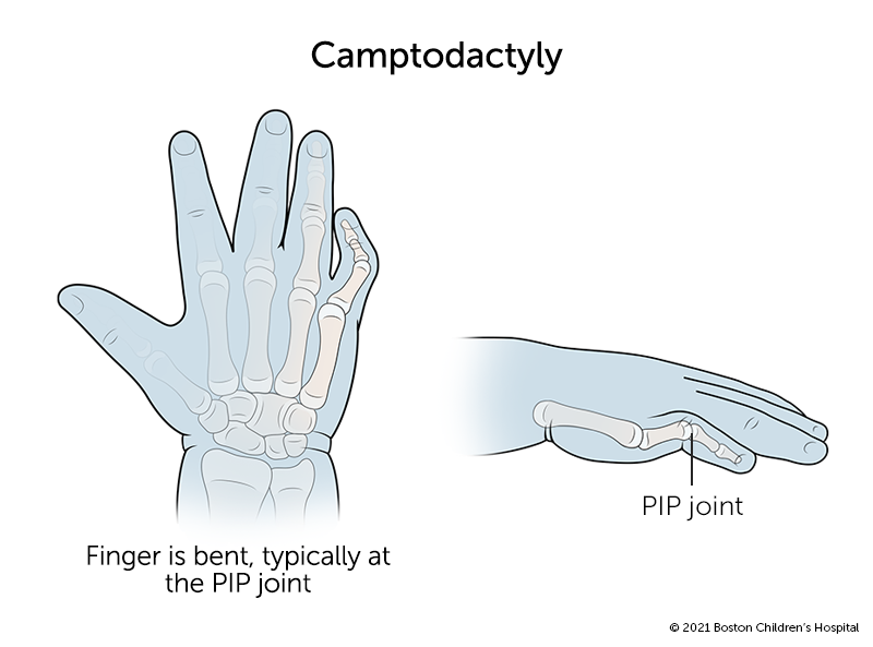 指间PIP关节近端异常弯曲的带有喜指畸形的小指。