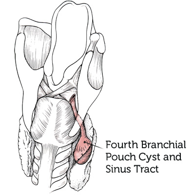 第四支链袋cyst and-sinus-tract