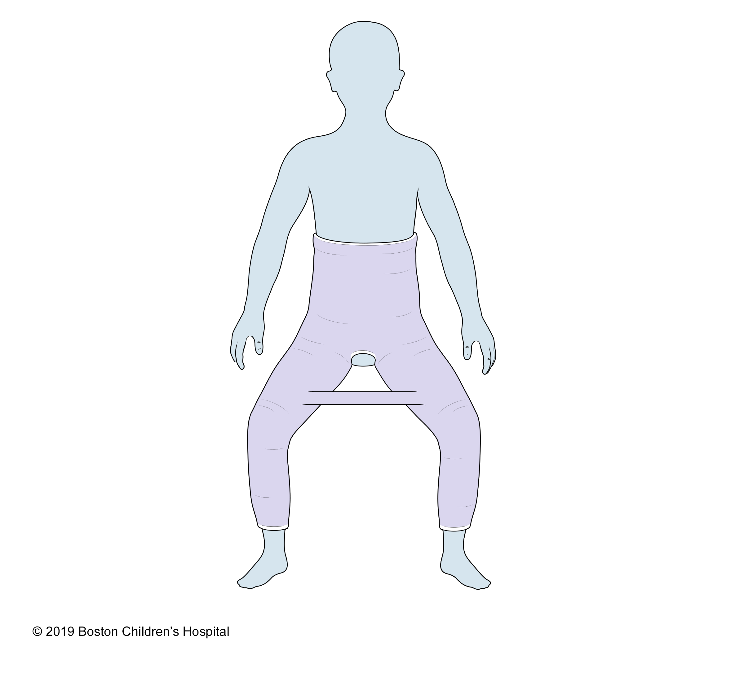 一个bilateral long leg hip spica cast (also known as a double hip spica cast)