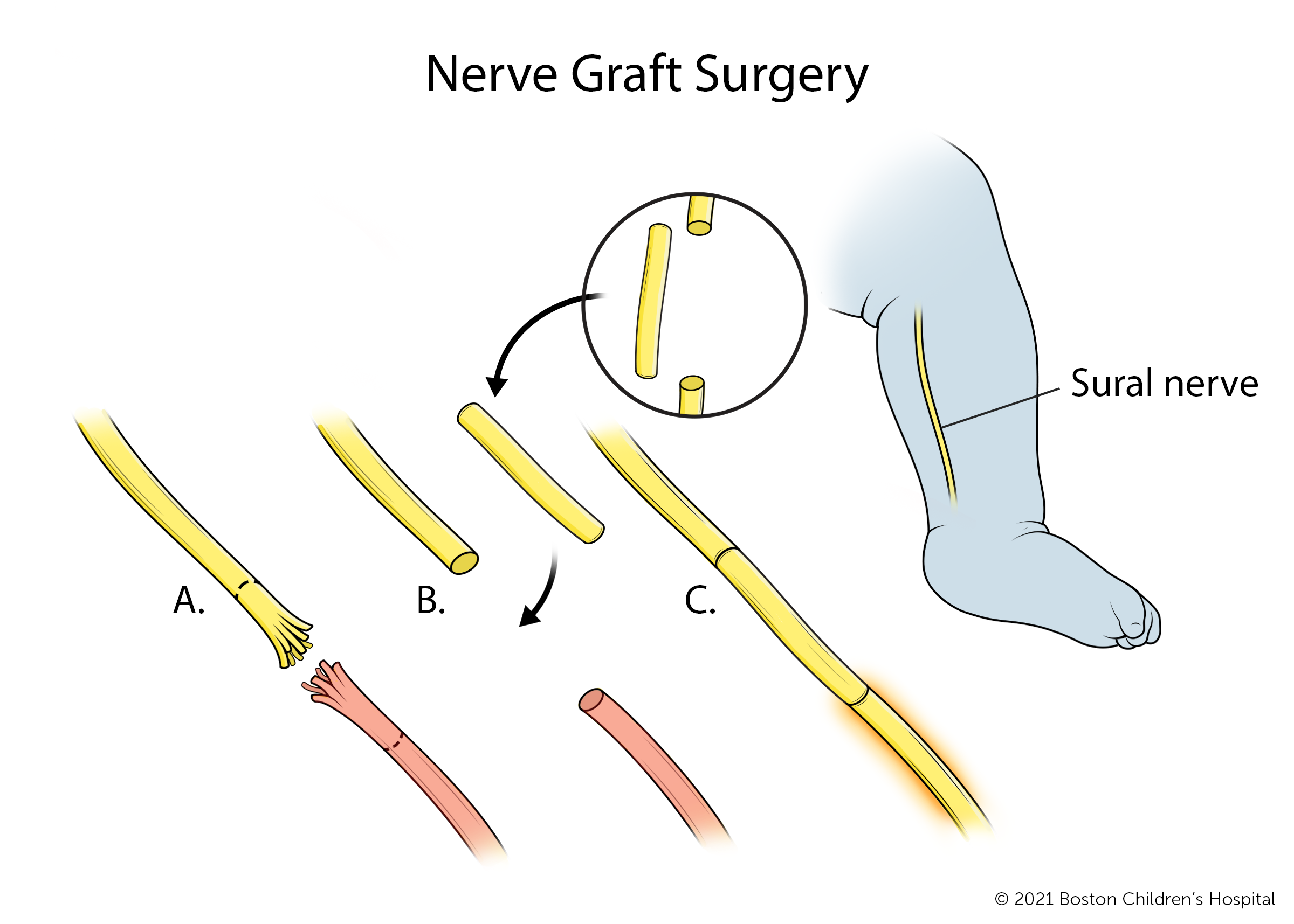 在神经移植物手术中，将臂丛神经受伤的部分切除，用腿部的腓肠神经部分代替。