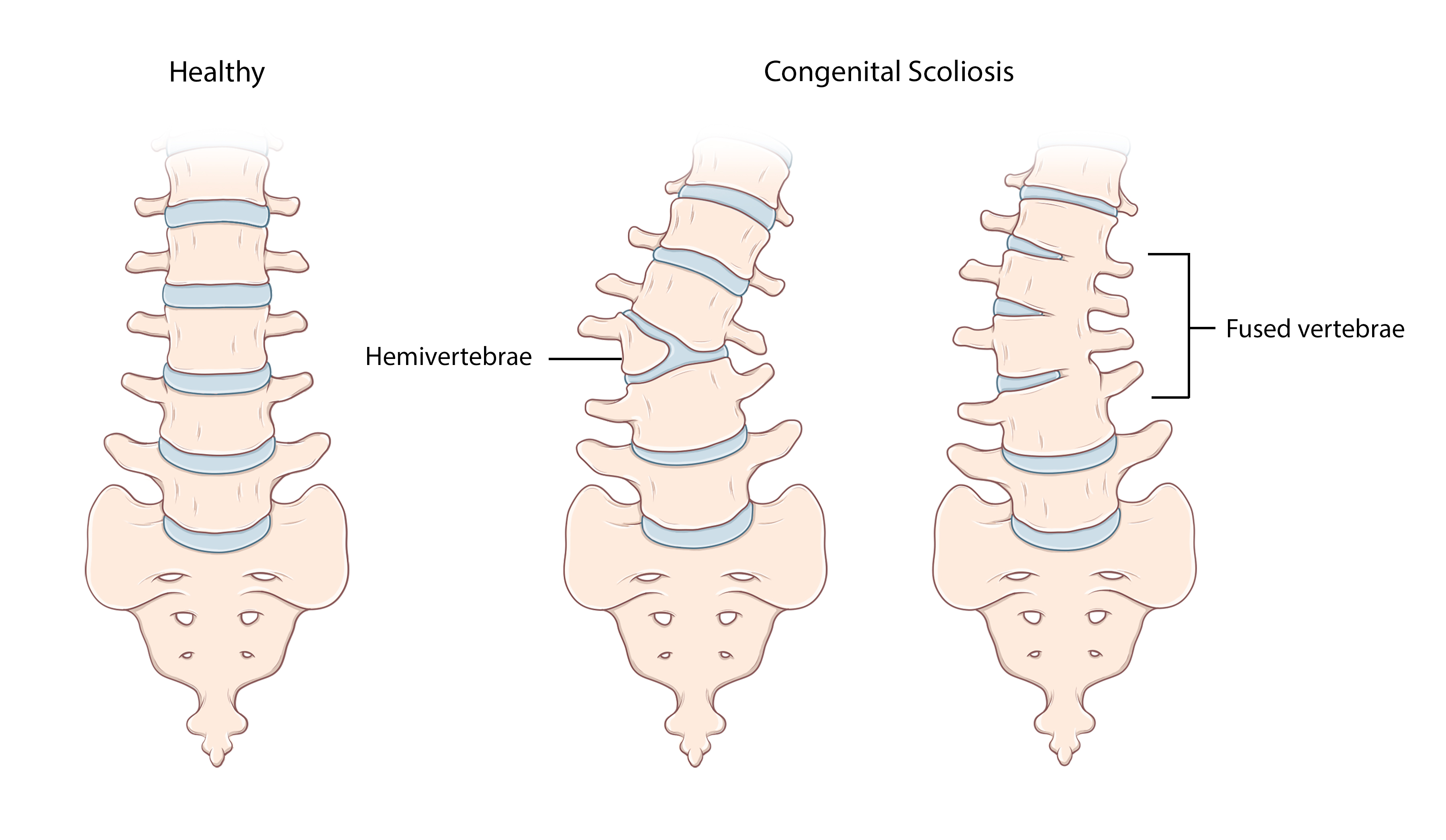 先天性脊柱侧弯发生在怀孕初期，当时脊柱中的一个或多个椎骨并没有完全形成。