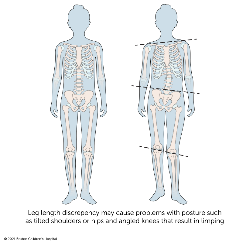 腿长差异可能会导致姿势问题，例如瓷砖肩膀或臀部和倾斜的膝盖。
