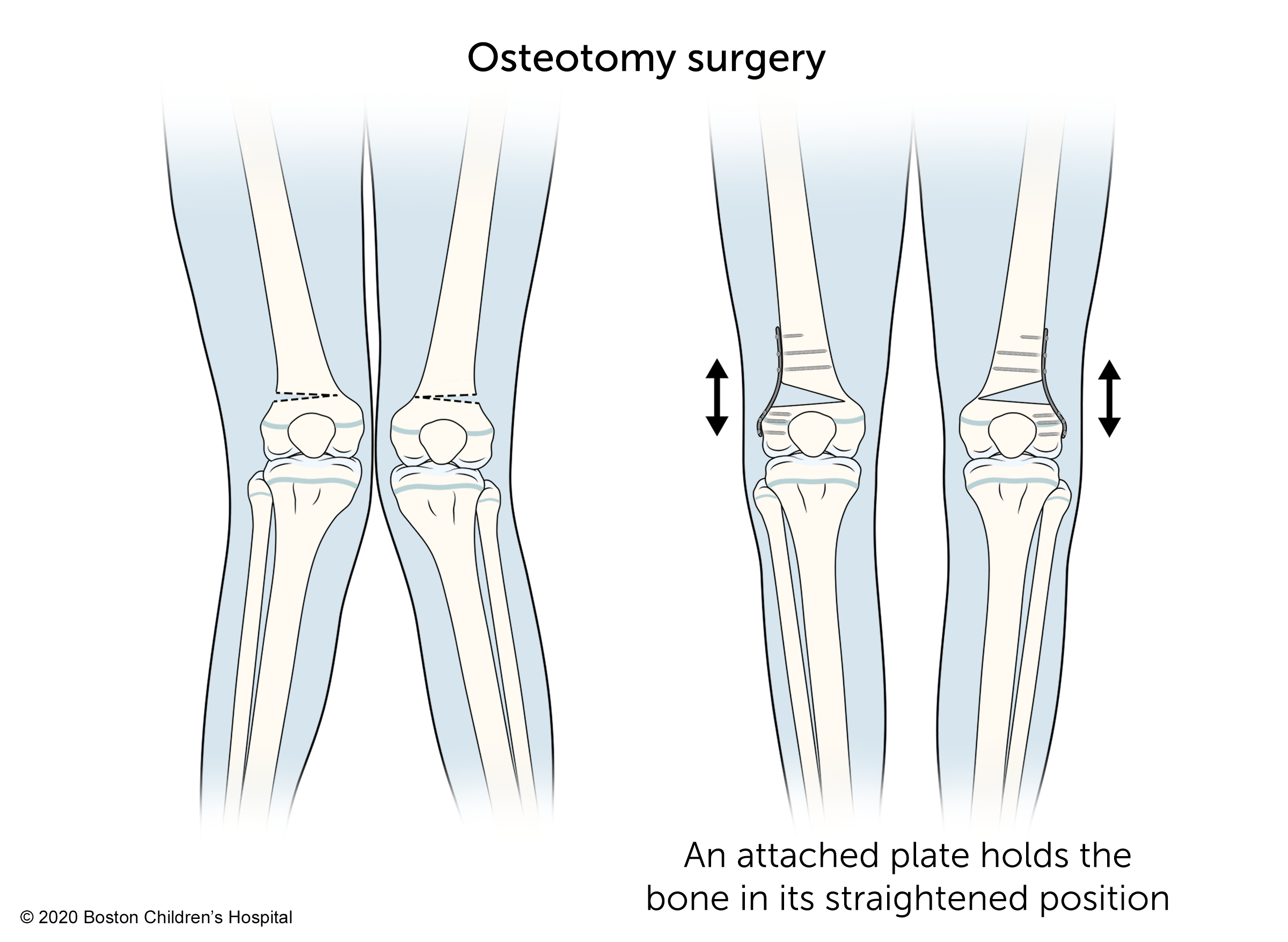 在截骨手术中，附着的钢板将骨固定在其拉直的位置。