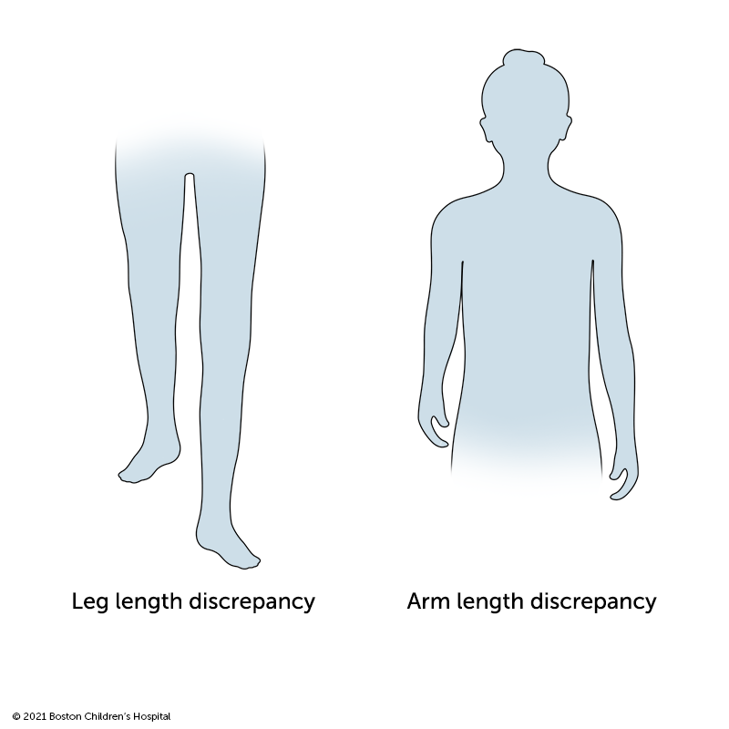 腿长差异和手臂长度差异