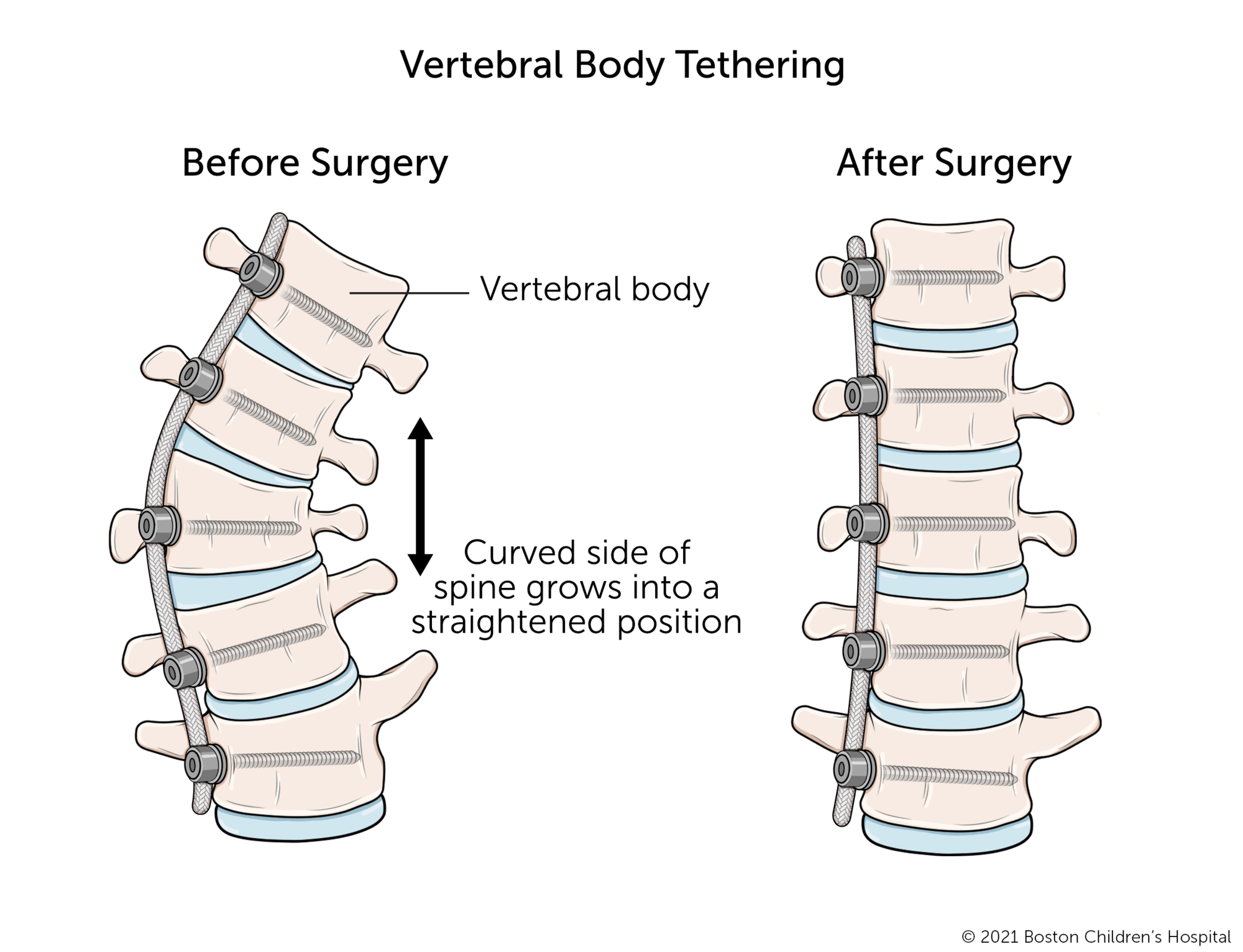 在椎体束缚的前后插图。在手术前，几个椎骨在一侧比另一方更短。在手术后将系绳连接到脊柱的弯曲侧，椎骨成长为均匀的形状，脊柱变得更直。
