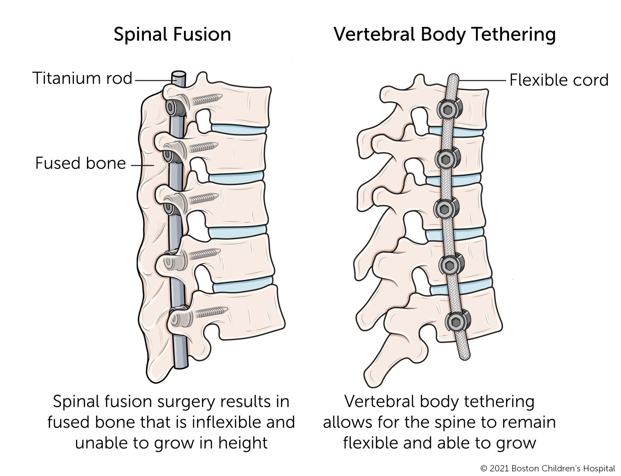 与椎体束缚相比，脊柱融合。脊柱融合手术导致融合的骨骼不灵活，无法高度增长。椎体束缚允许脊柱保持柔韧且能够生长。