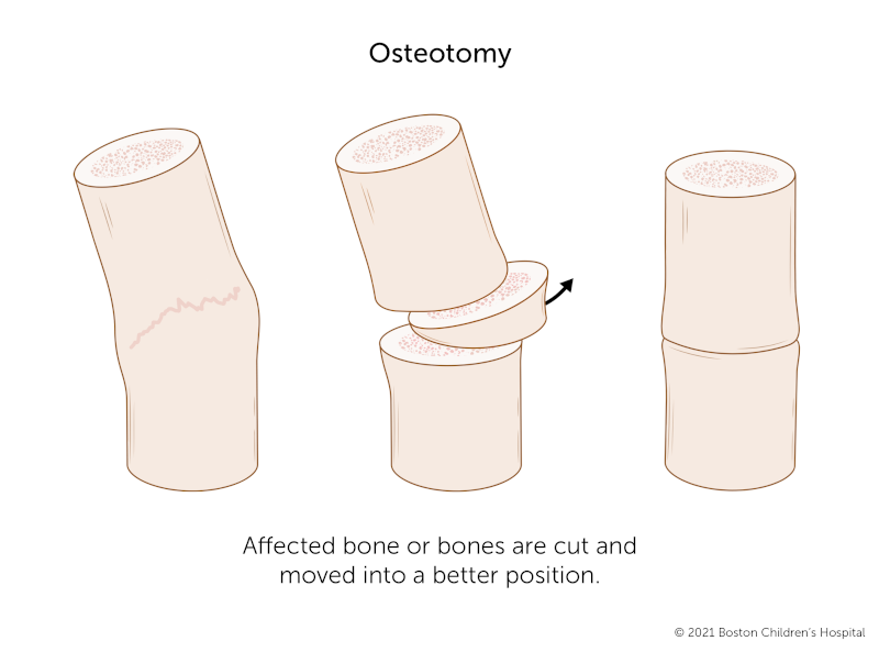 在修复畸形愈合的截骨术中，骨头被切断并重新定位到一个更直的位置。