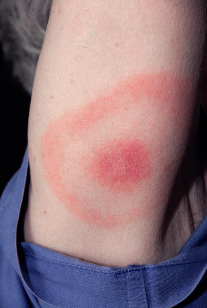 牛眼状皮疹是蜱虫叮咬的症状之一。(来源:美国疾病控制与预防中心/詹姆斯Gathany)