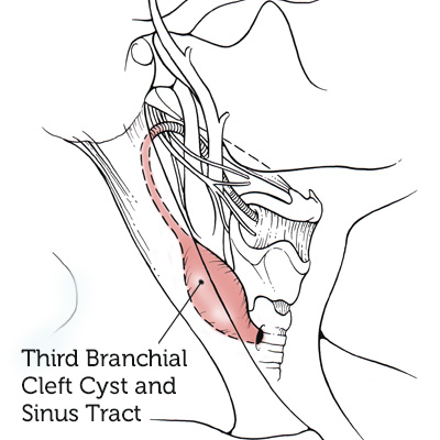 第三支链路cyst-sinus-tract