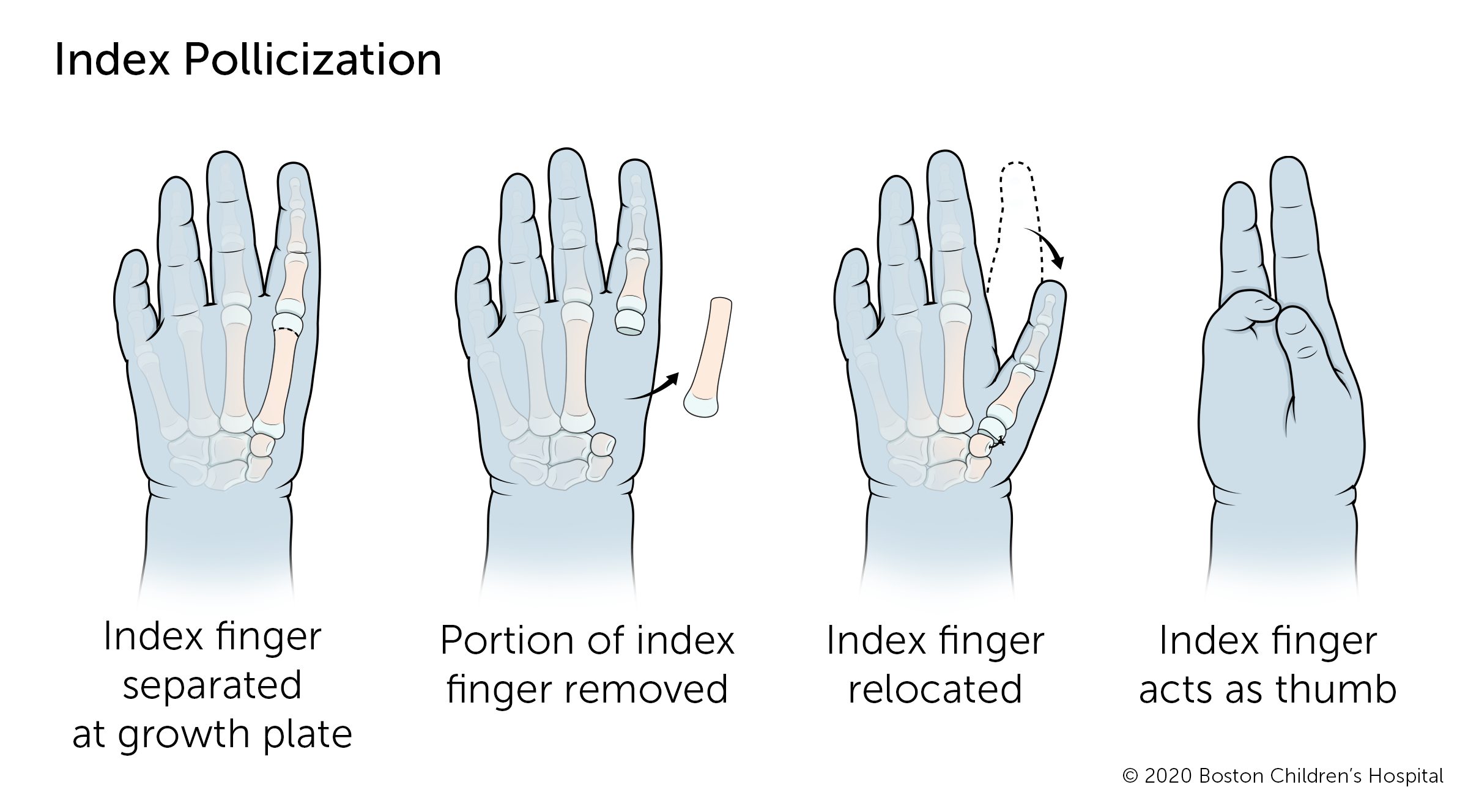 如果拇指完全缺失，则指数污染手术将食指移至拇指位置。食指在生长板上分离，手指的一部分从手中移开，其余的手指将其重新定位到可以用作拇指的地方。