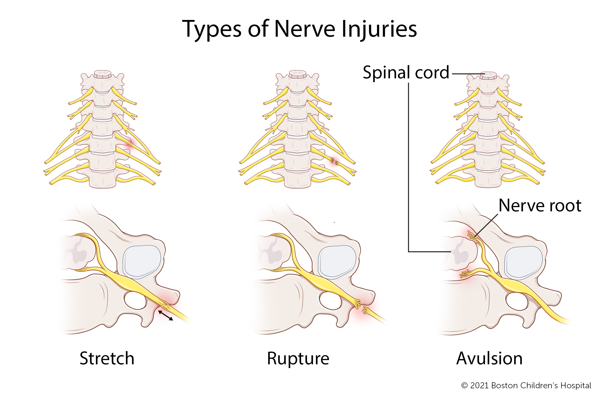 在臂丛伸展性损伤中，神经只是被拉伸，而不是撕裂。在臂丛神经断裂损伤中，神经被撕裂，但仍然附着在脊髓上。在臂丛神经撕脱伤中，神经根已与脊髓分离。