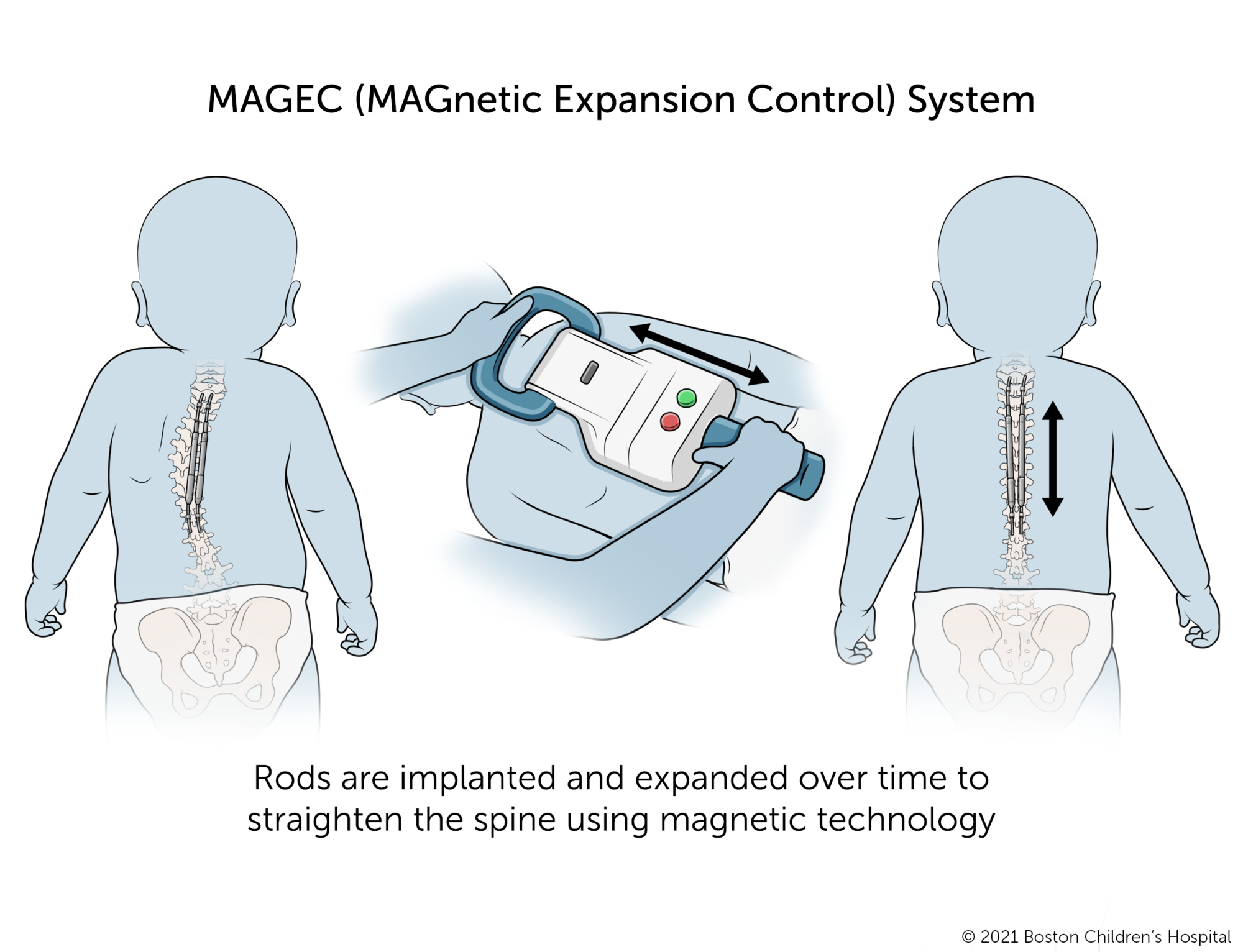 MAGEC(磁膨胀控制系统)。随着时间的推移，植入的脊柱杆会随着磁性技术慢慢膨胀，使脊柱变直。