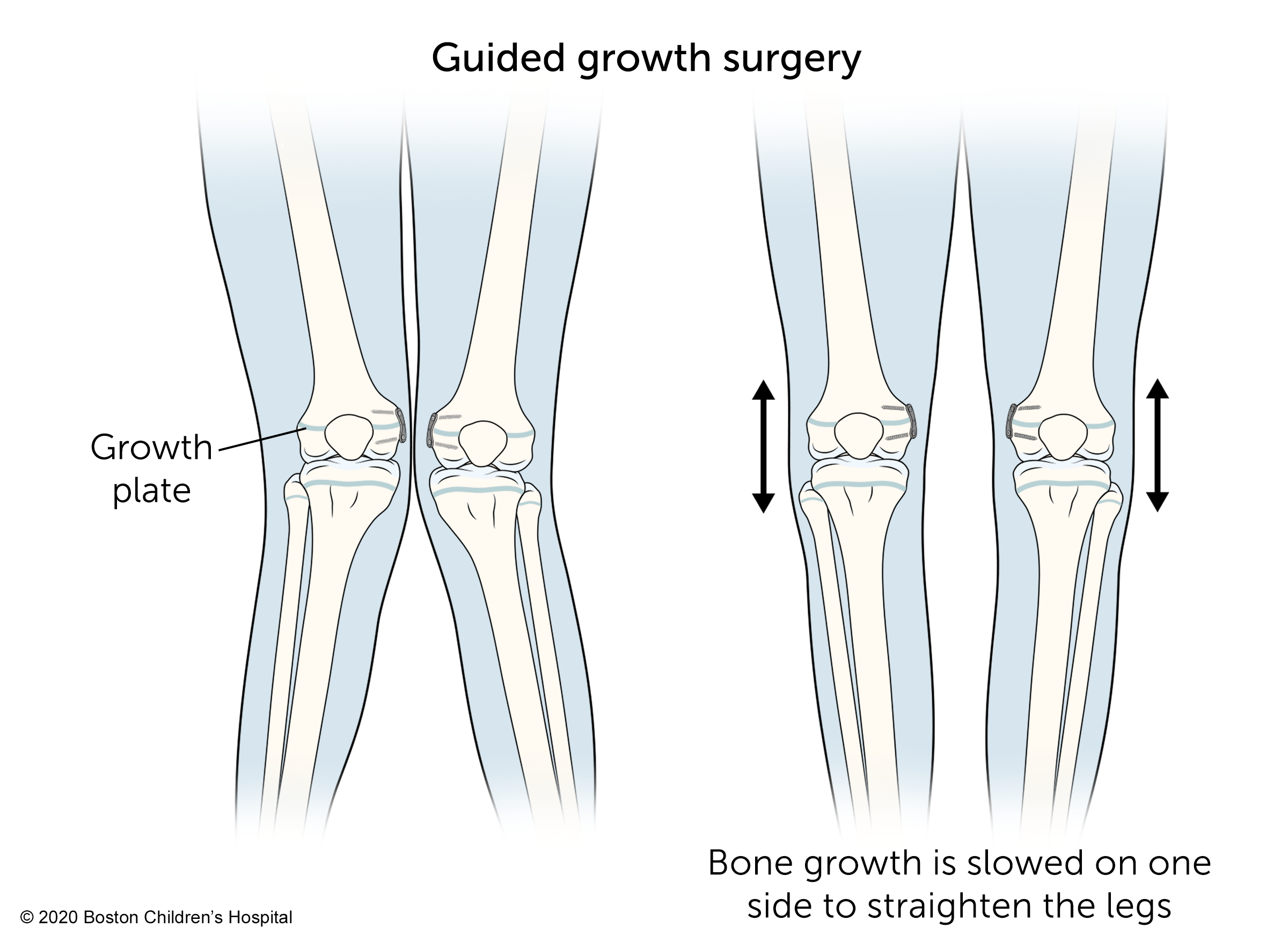 在引导生长手术中，一侧的骨骼生长减慢，以使腿部伸直。