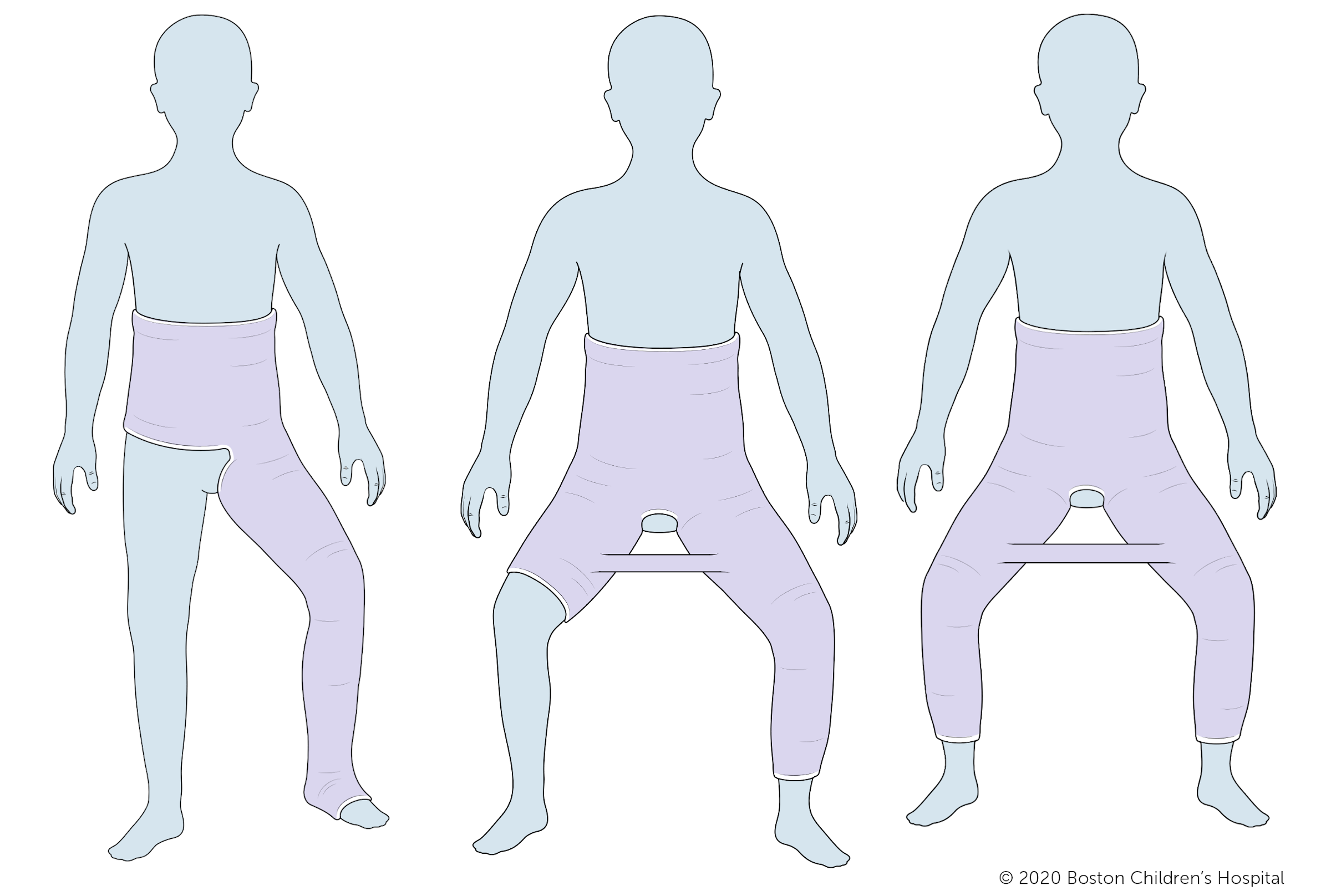 三种类型的石膏，从左起:单侧髋关节spica石膏，一个半髋关节spica石膏和双侧长腿髋关节spica石膏。