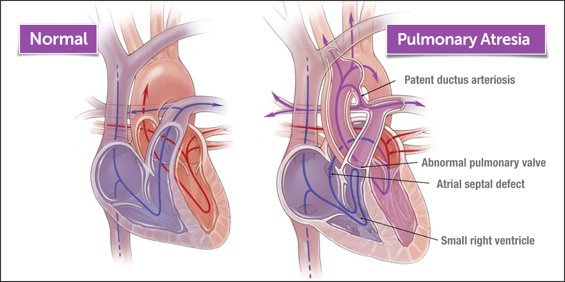 正常心脏和肺闭锁心脏的图像