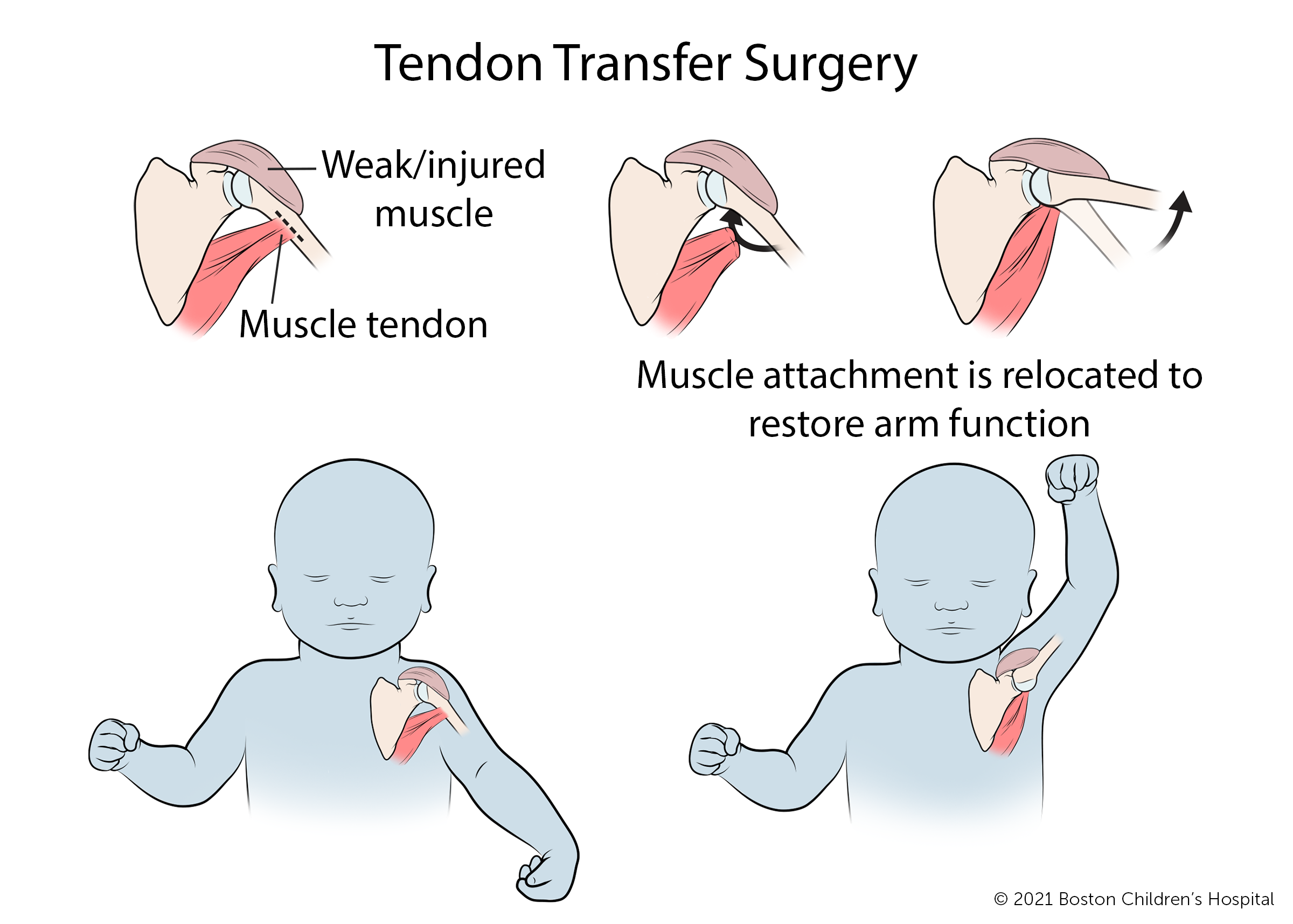 肌腱转移手术是将弱肌或损伤肌的肌腱与正常附着点分离，在新的位置重新附着，以恢复手臂功能。