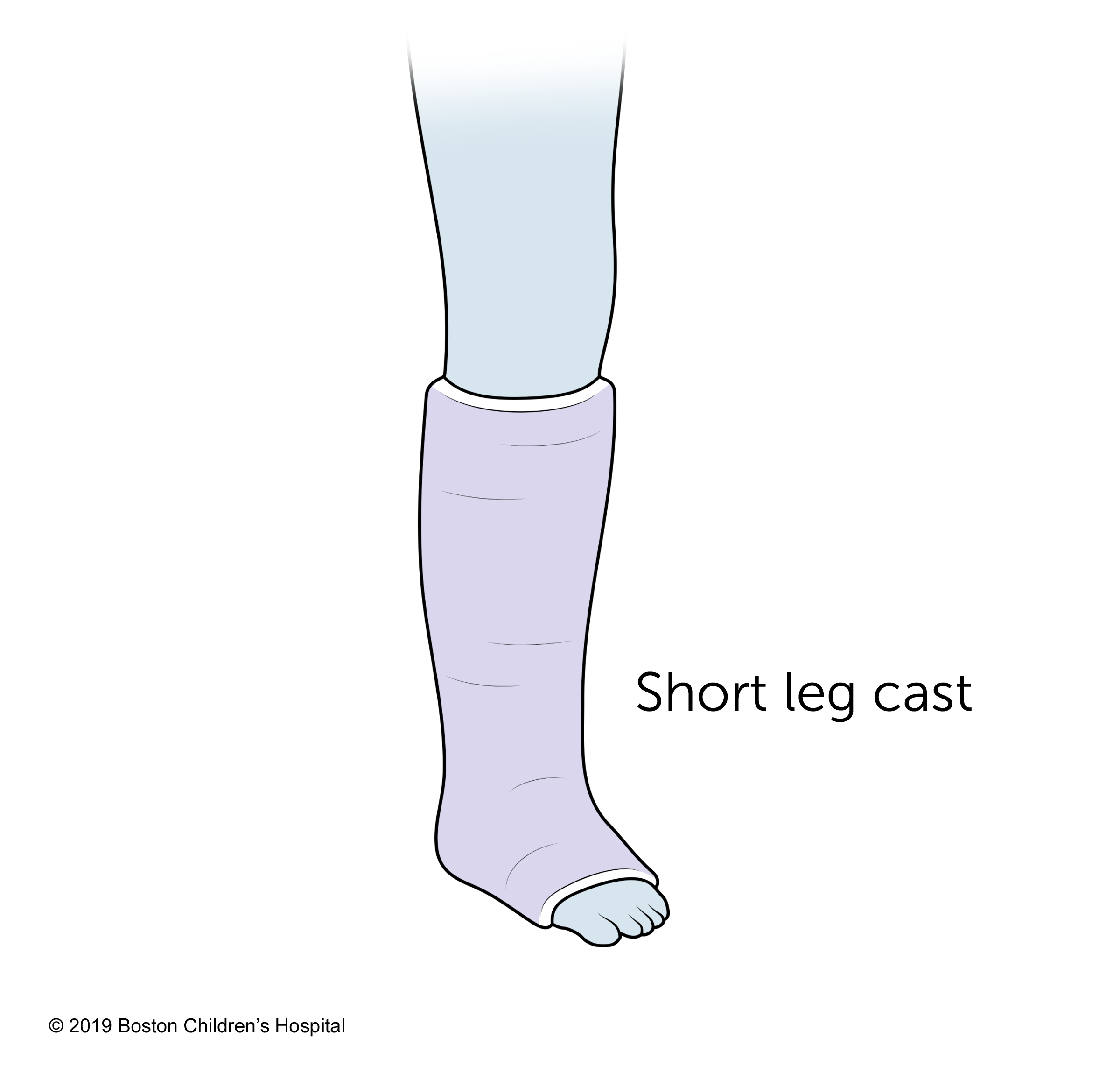 一个short leg cast.