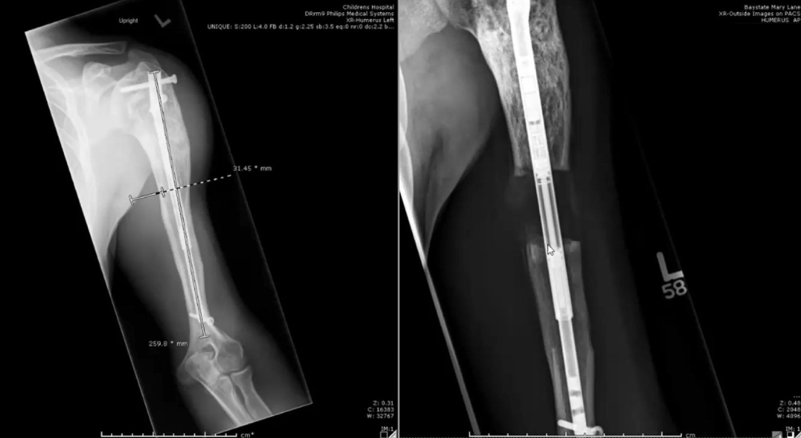 两张病人左臂的x光片，在手臂延长的两个阶段。在第一个实验中，一根延长棒通过手术连接到上臂的骨头上。在第二种情况下，骨头已经被切割，骨头两端之间有一个空间，棒支撑着它。在这个空间可以看到新的骨骼生长。