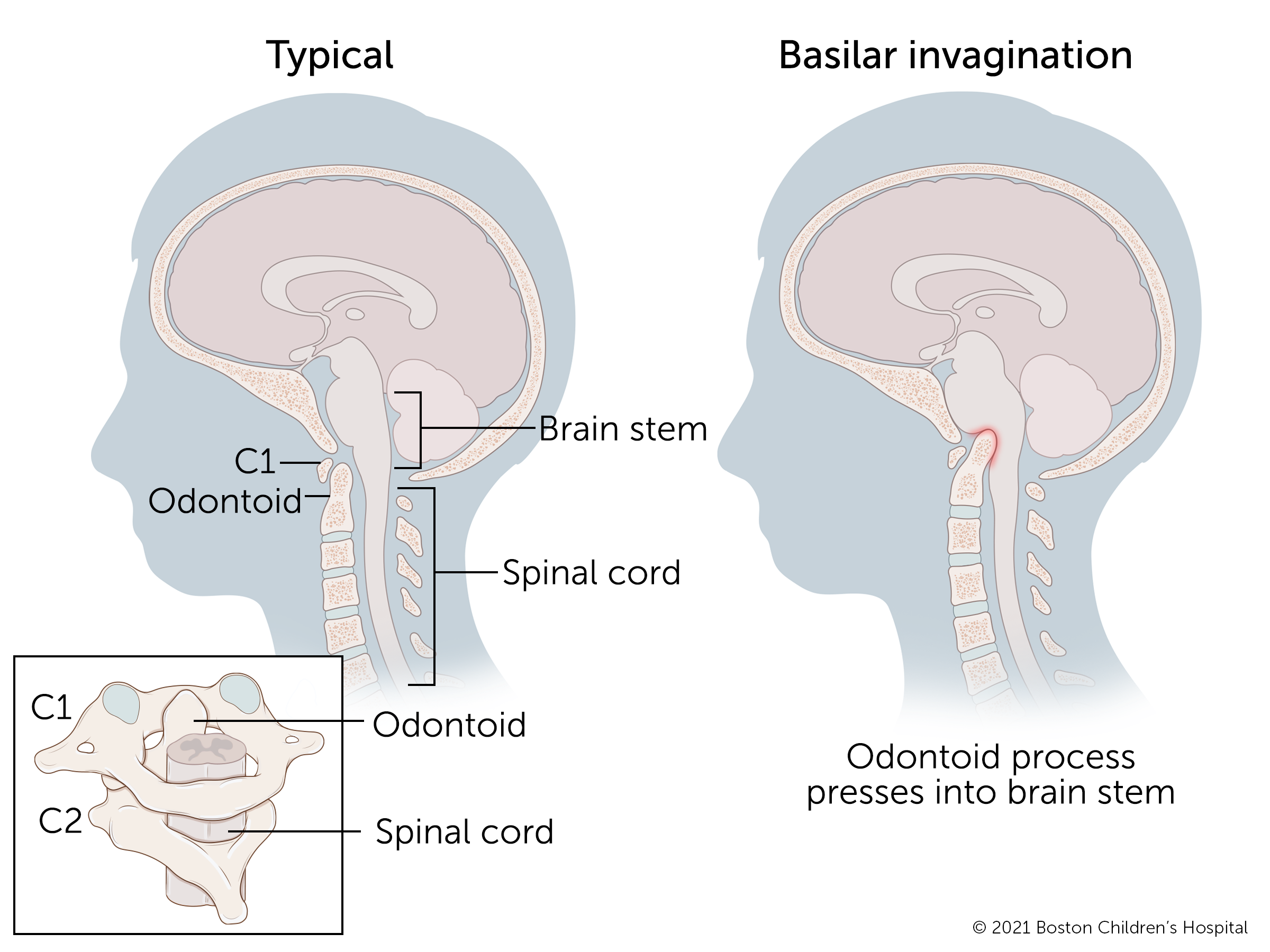 当一个孩子有颅底凹陷症时，他们脊柱顶部的一个突起会压迫他们的脑干。