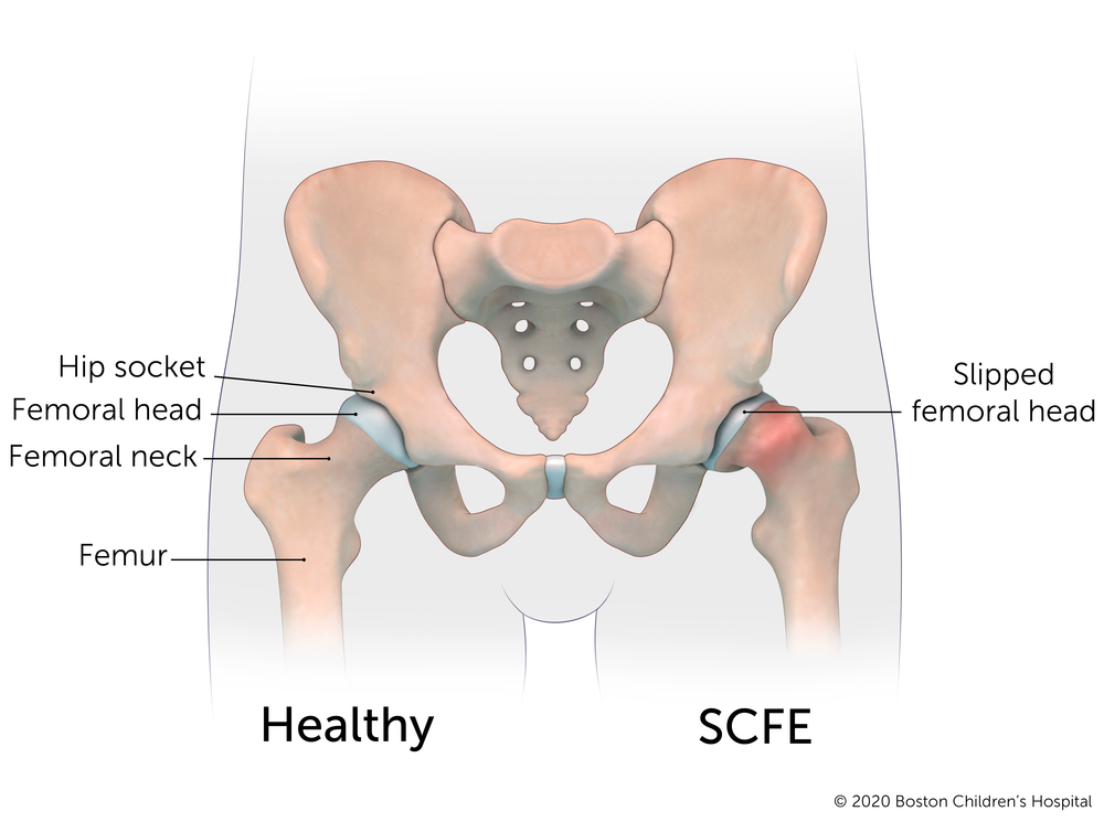 这是健康的髋关节和股本股骨骨epip骨滑倒的髋关节之间的区别。