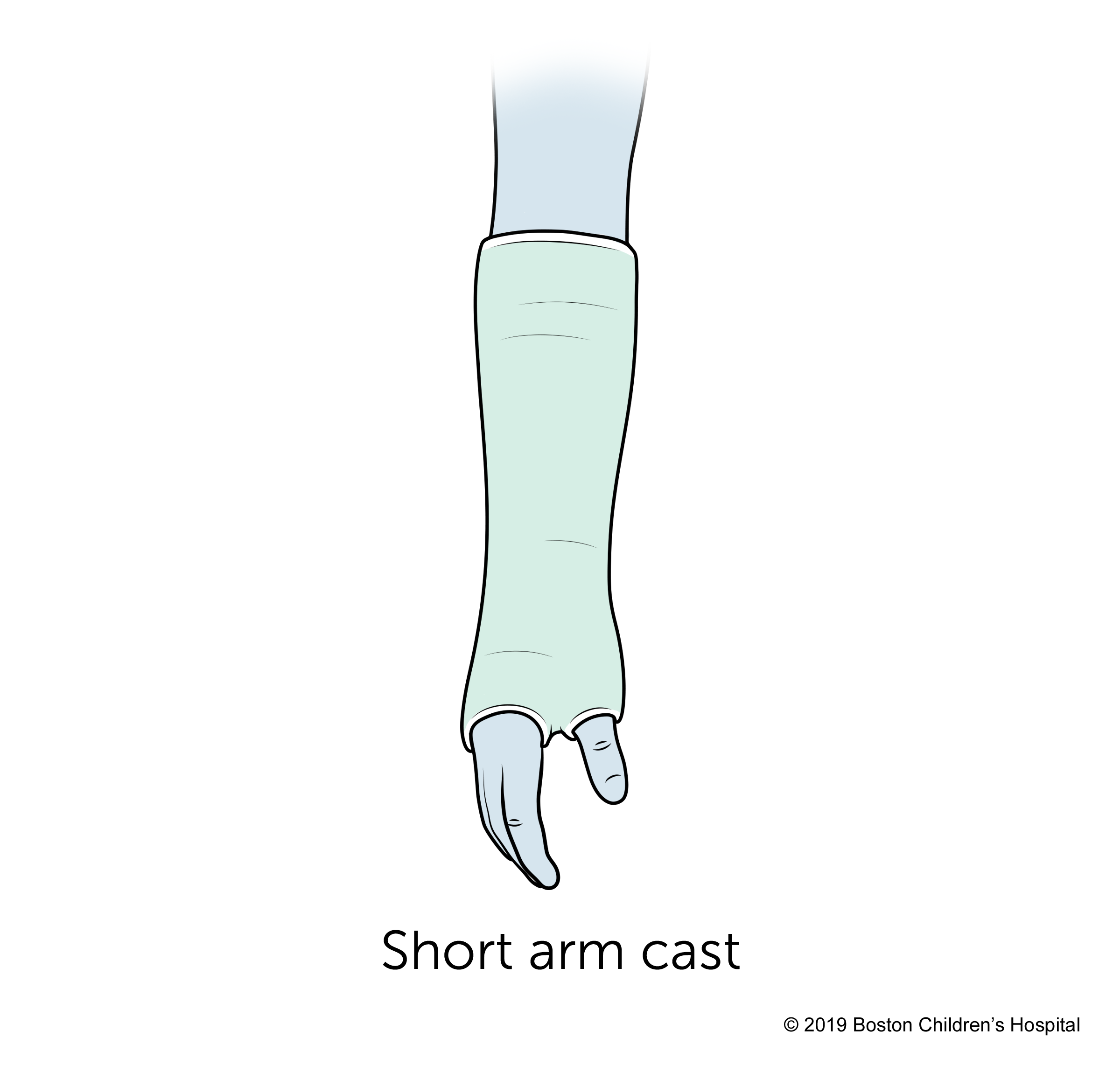一个short arm cast.