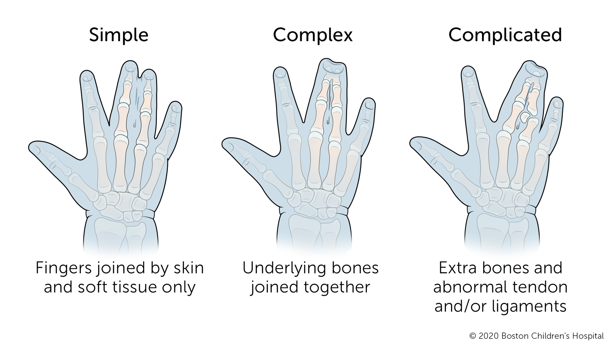 单纯并指指指间仅通过皮肤和软组织连接。复杂的并指意味着下面的骨头也连接在一起。复杂的并指意味着有多余的骨头和异常的肌腱和/或韧带发育。