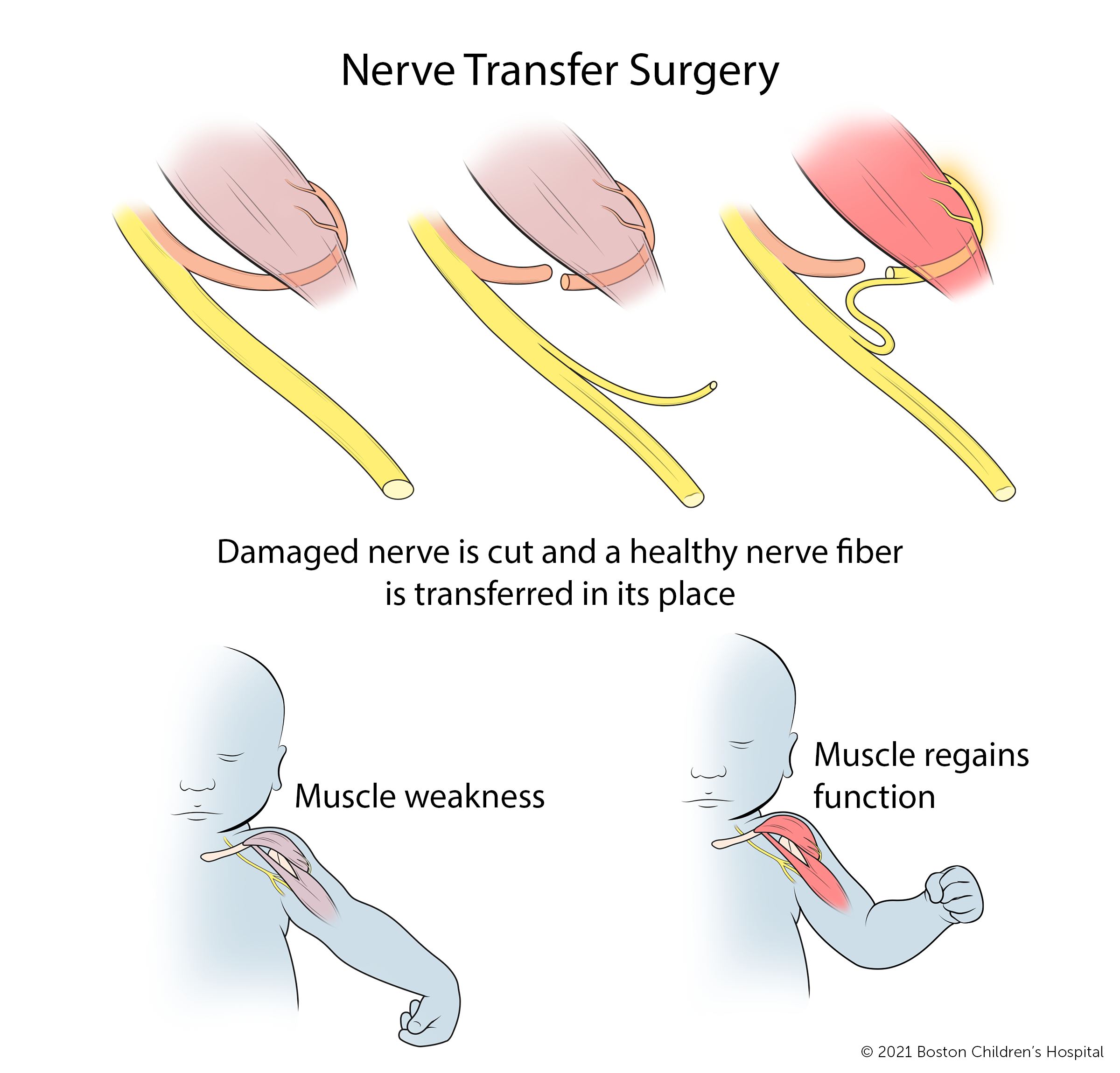 在神经转移手术中，损伤的神经被切断，健康的神经纤维被转移到它的位置。随着时间的推移，肌肉无力区域恢复功能。