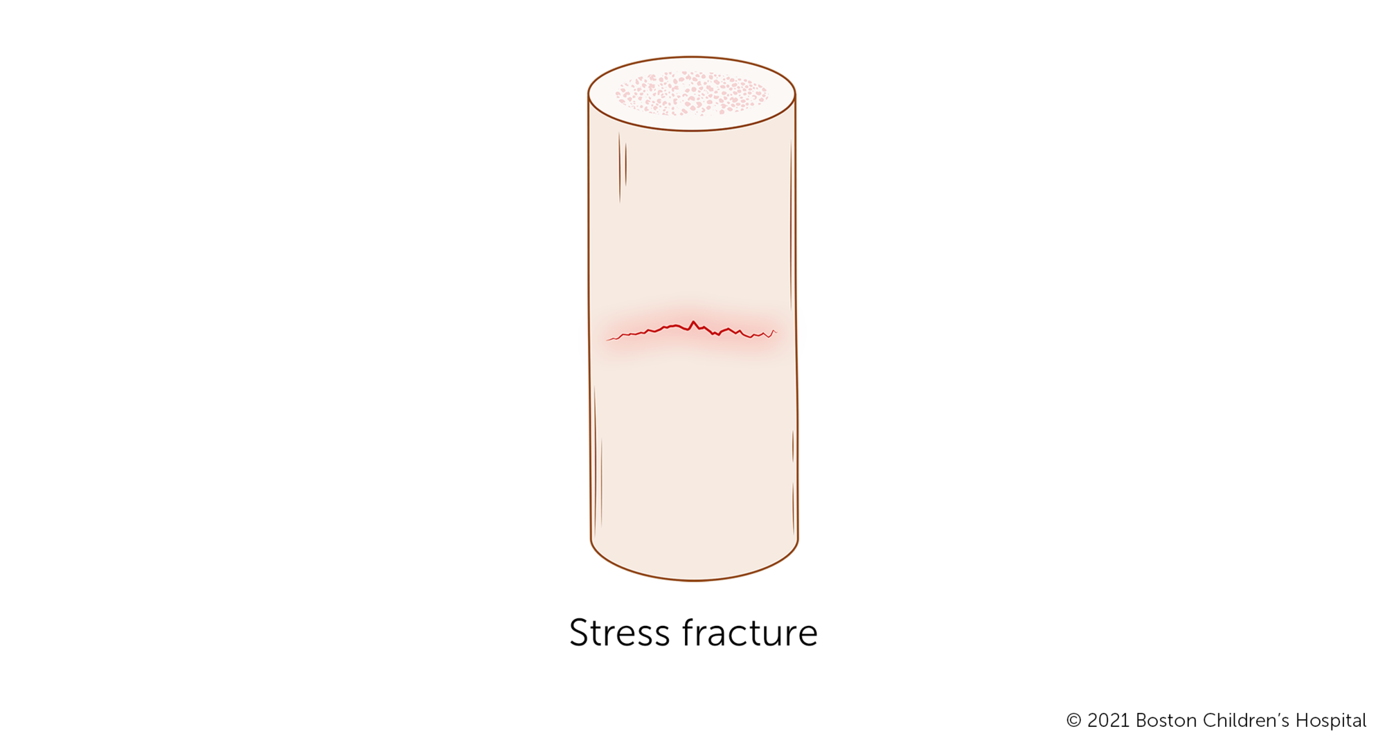 应力性骨折是一种tiny crack that does not go all the way through the bone.