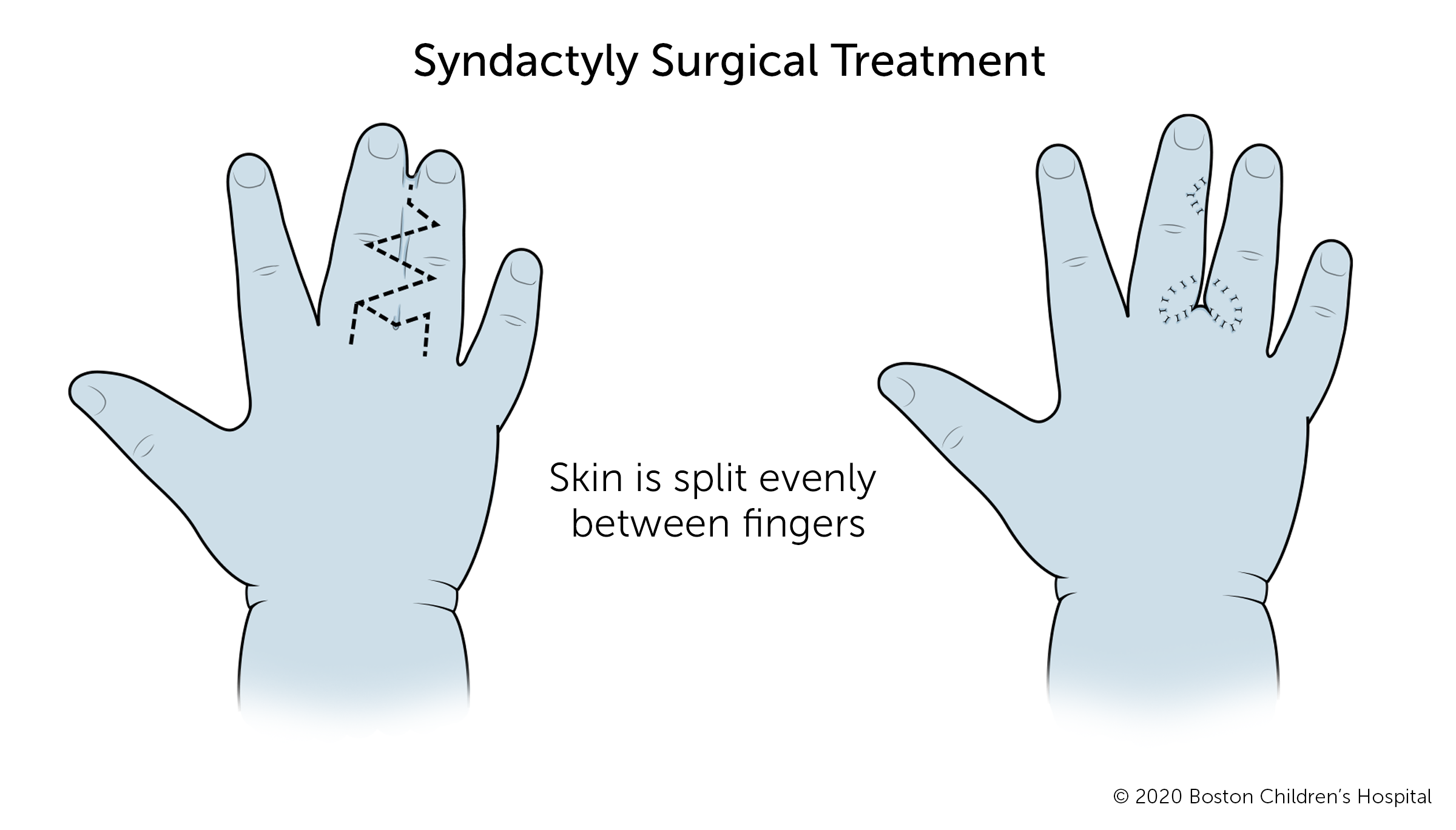 这是手术分离的连体手指的前后对比图。手术时皮肤在手指间均匀分开。