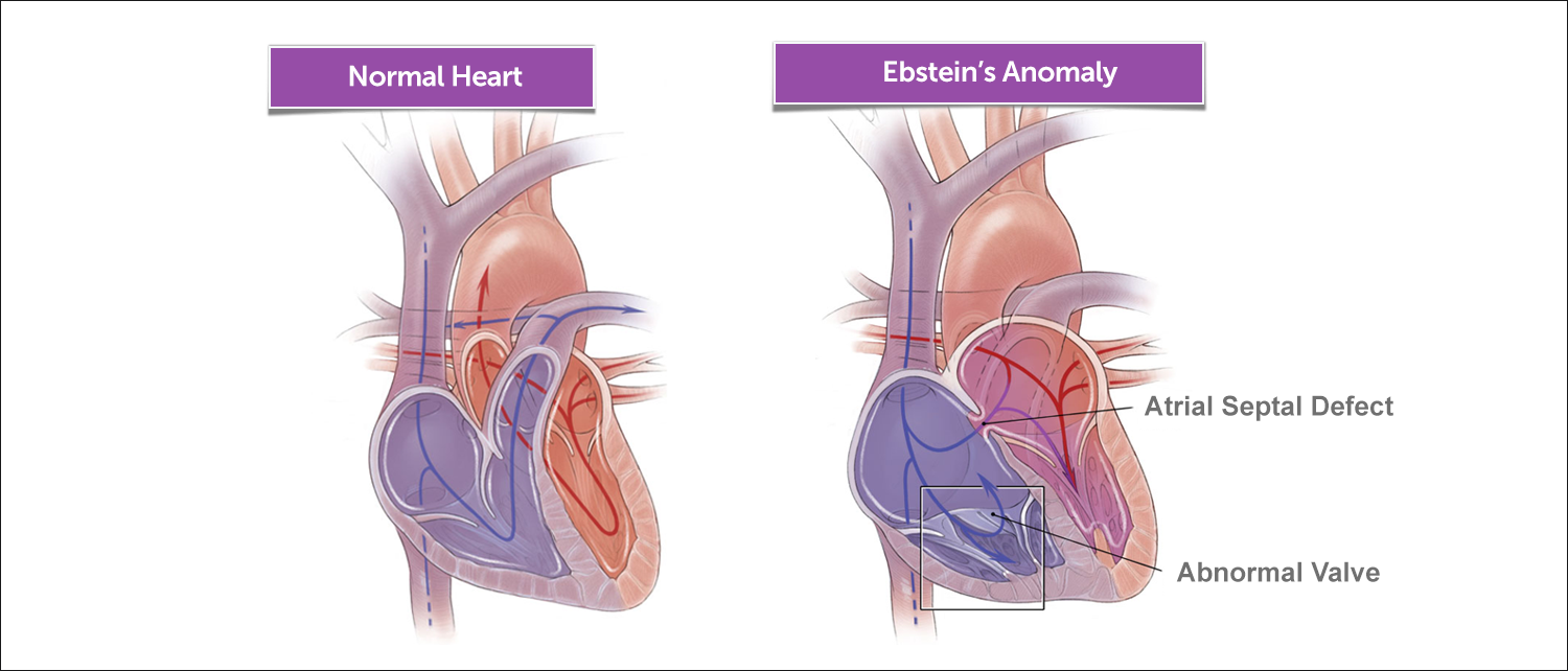 正常心脏和Ebstein异常心脏的示意图