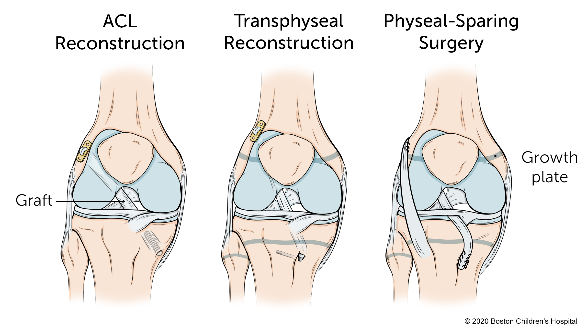 有三种类型的手术:ACL重建，transphyseal重建和物理保留手术。