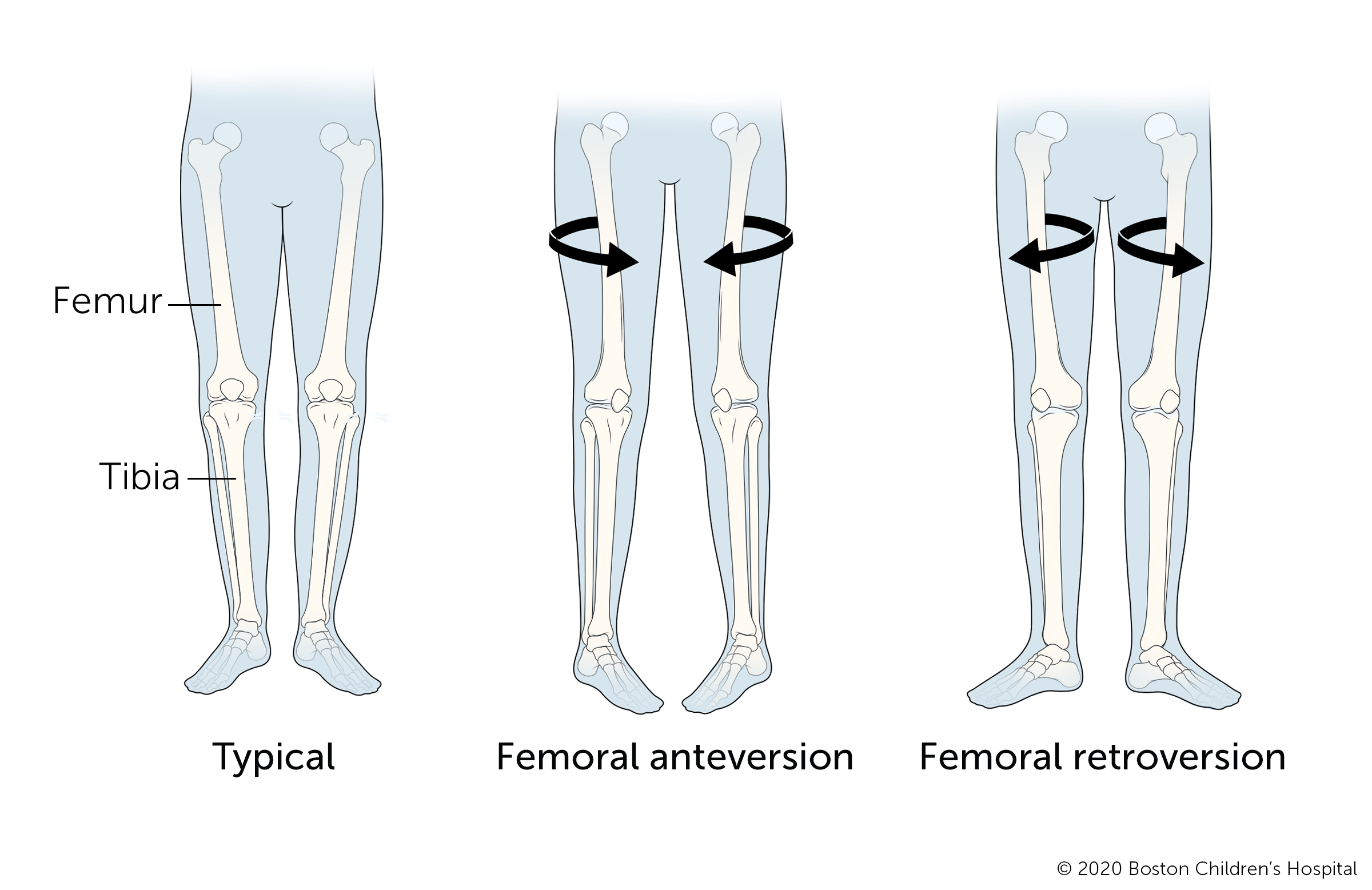 典型的腿，具有股骨前的腿以及带有股骨逆转的腿。