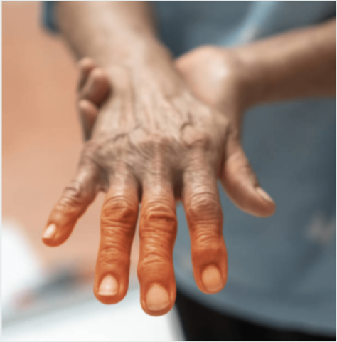 一只手的图象有转动橙色的手指的手指，这是狼疮的症状。