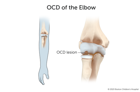 肘关节剥脱性骨软骨炎是指肘关节的一段骨头与其他骨头分离。