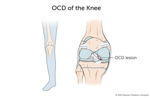膝关节解剖性剥脱性骨炎是指膝关节的一段骨与其他骨分离。