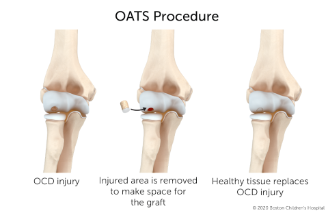 OATS手术通过从身体其他部位取下健康组织，替换受伤的骨头和软骨，来修复剥脱性骨软骨炎。
